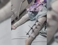 Médicos se confundem e operam perna errada em menina de 6 anos, na Paraíba