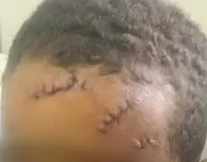 Criança de 8 anos é ferida por foice lançada por vizinho em Picuí, Paraíba
