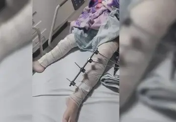 Hospital de Trauma de CG afasta médicos após realizarem cirurgia em perna errada de criança