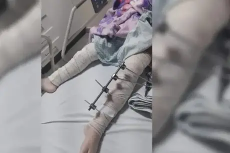 Hospital de Trauma de CG afasta médicos após realizarem cirurgia em perna errada de criança